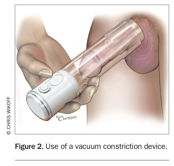 Erectile dysfunction. Part 2 Management of ED unresponsive to